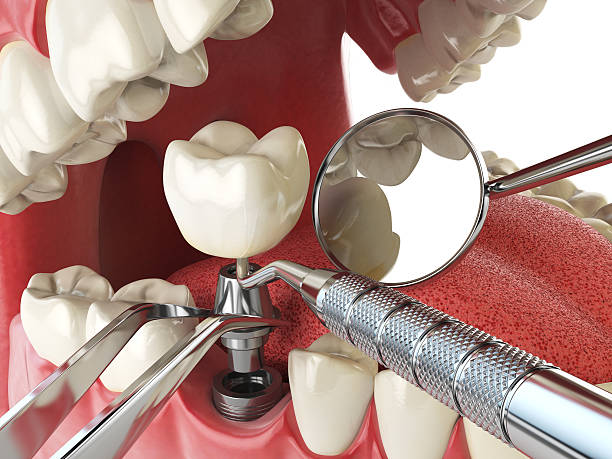Best Emergency Dental Extractions in San Antonio Heights, CA